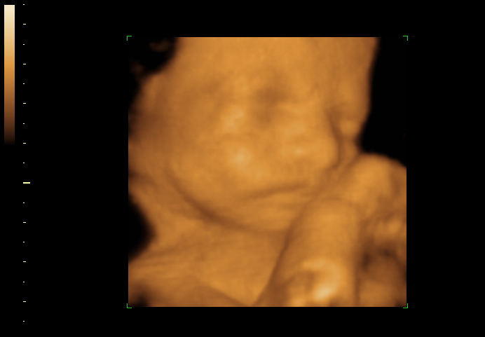 3D ultrasound image at 25 weeks